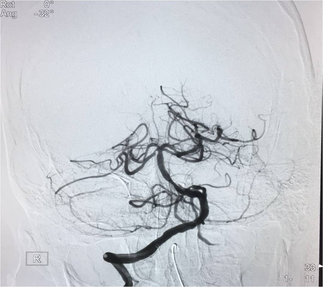 取栓慢性闭塞如何避免血栓逃逸,急性大脑中动脉栓塞取栓时间