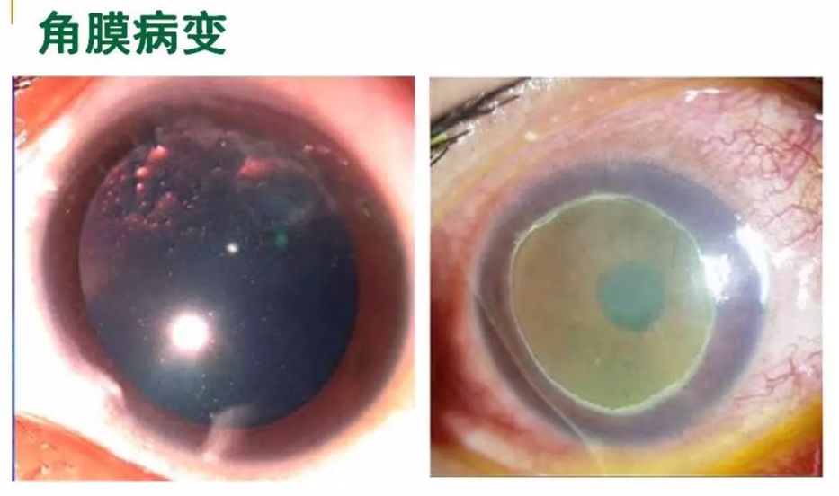 眼周过敏中医治疗,眼周过敏的症状图片