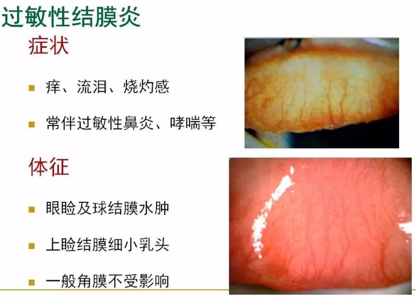 眼周过敏中医治疗,眼周过敏的症状图片