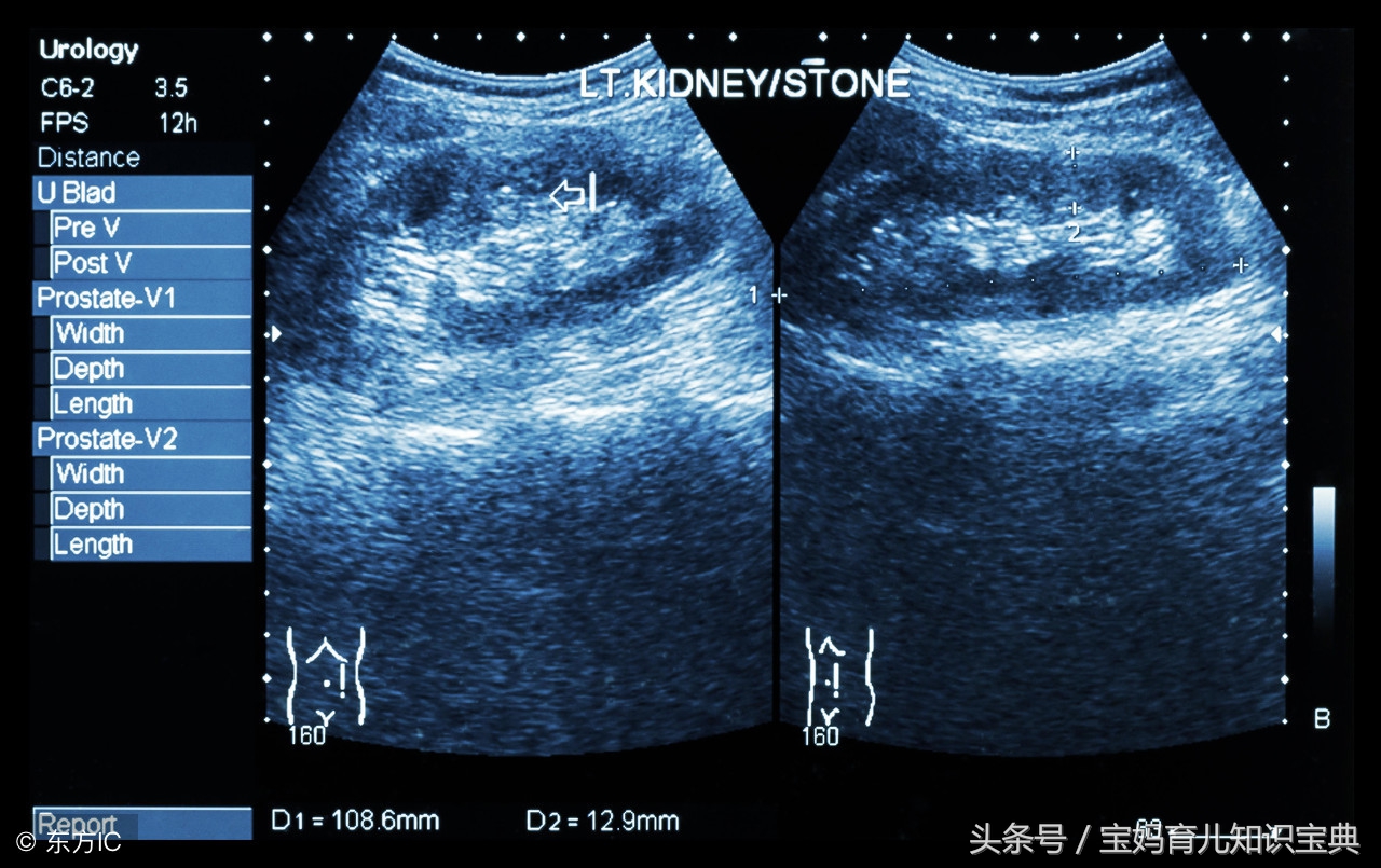 孕妈生二胎早产14天得知是三胞胎,一胎单胎顺产二胎双胞胎