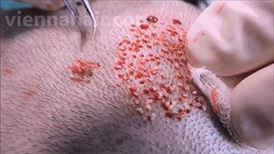 麦当劳薯条治疗脱发,麦当劳薯条掉头发