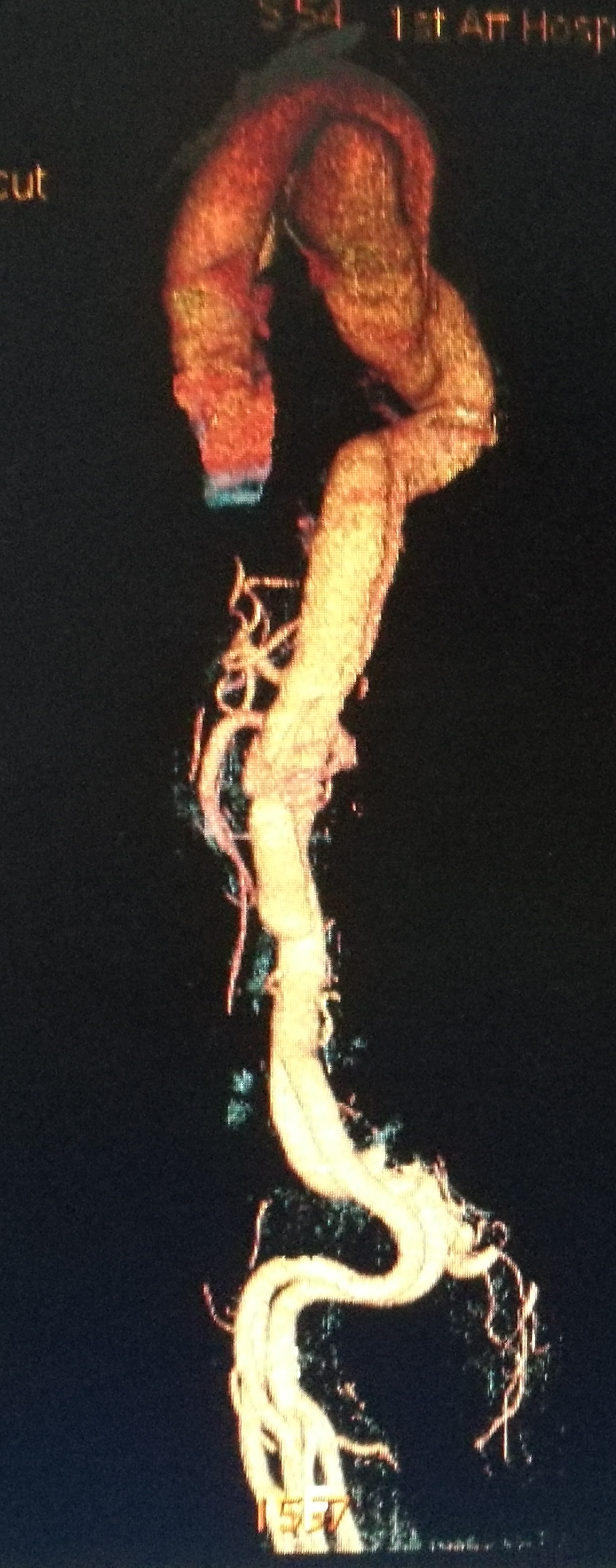 一例凶险主动脉夹层的超声诊断,慢性夹层直径超过5厘米