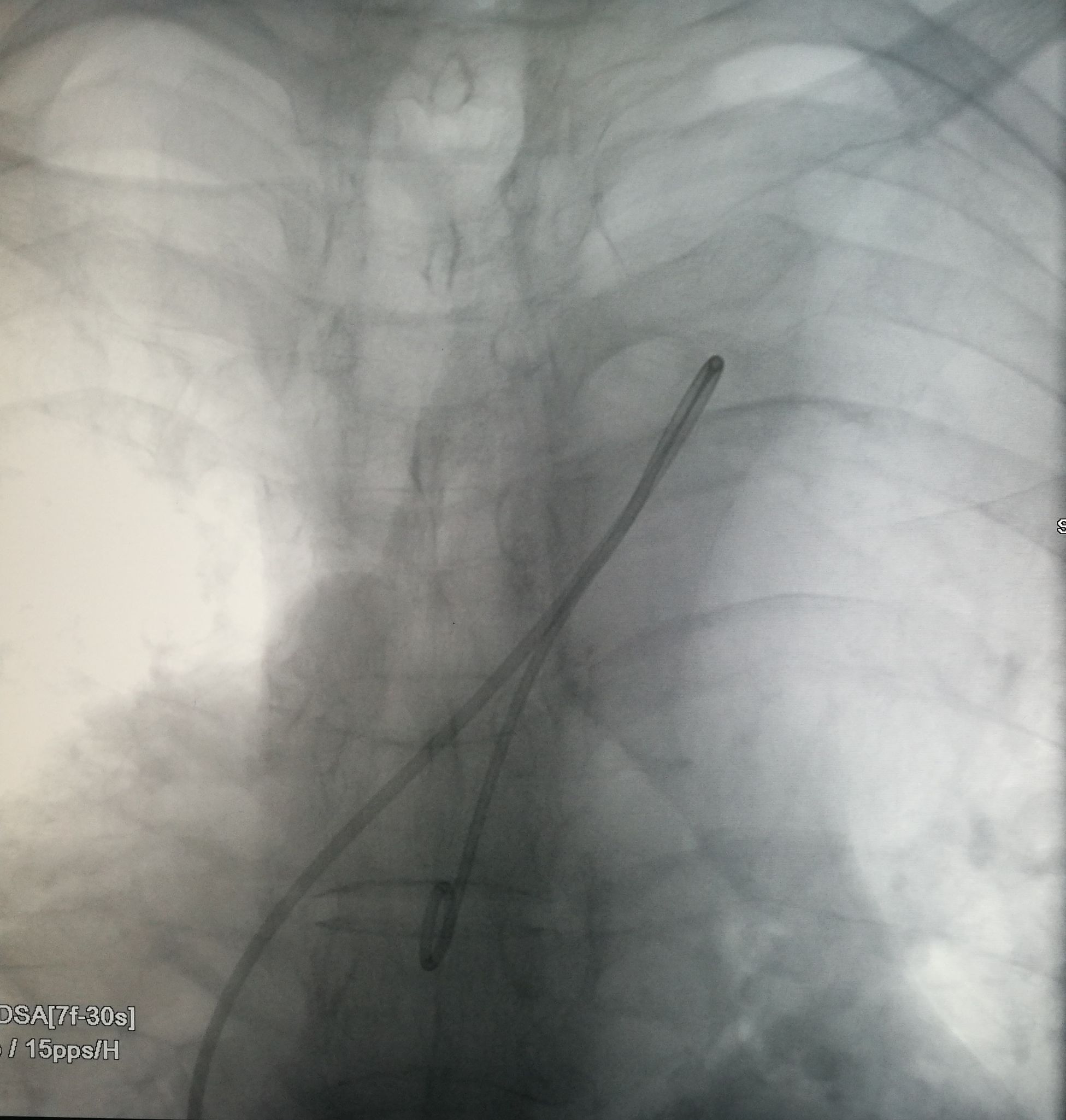 一例凶险主动脉夹层的超声诊断,慢性夹层直径超过5厘米