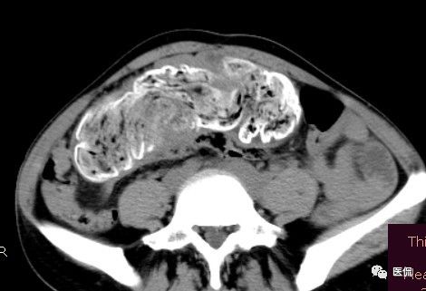 手术纱布遗留在体内可以吸收吗,手术纱布忘了取出会怎样