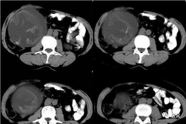 手术纱布遗留在体内可以吸收吗,手术纱布忘了取出会怎样