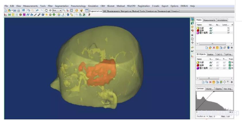 医学3d动画演示脑出血手术,3d演示脑出血治疗过程