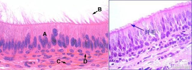 支气管扩张能治好吗,支气管扩张可以完全治愈吗