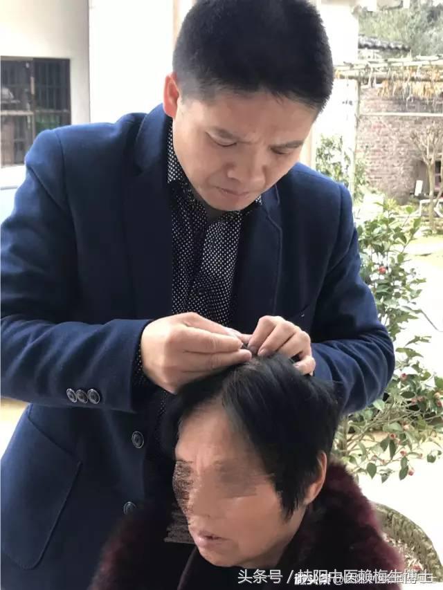 内针治疗带状疱疹剧烈疼痛4例分析