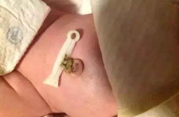 月嫂分享：新生儿肚脐5个异常要注意！