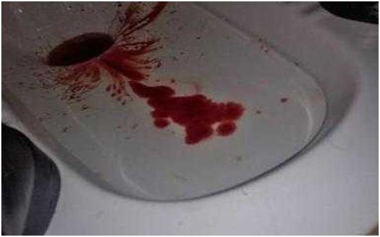 痔疮的症状怎么治疗,热痔疮和寒痔疮的区别