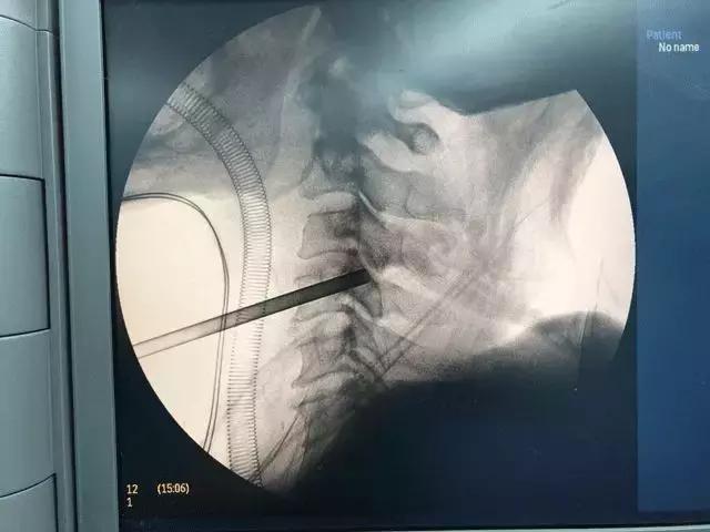 老人腰椎间盘突出需要微创手术吗,老人颈椎突出挺厉害能复位吗