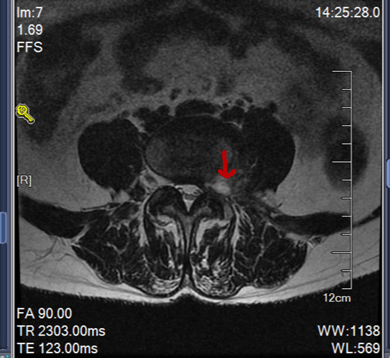 腰突和腰脱的磁共振片子,腰脱磁共振