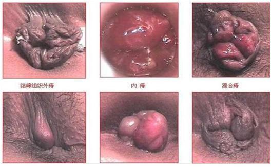 痔疮破裂便血怎么治疗,痔疮便血后身体发虚