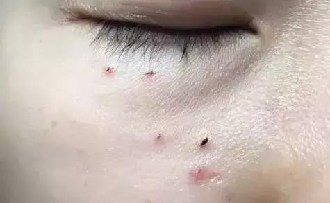 不用针挑刺,不用针挑刺还有什么办法能挑