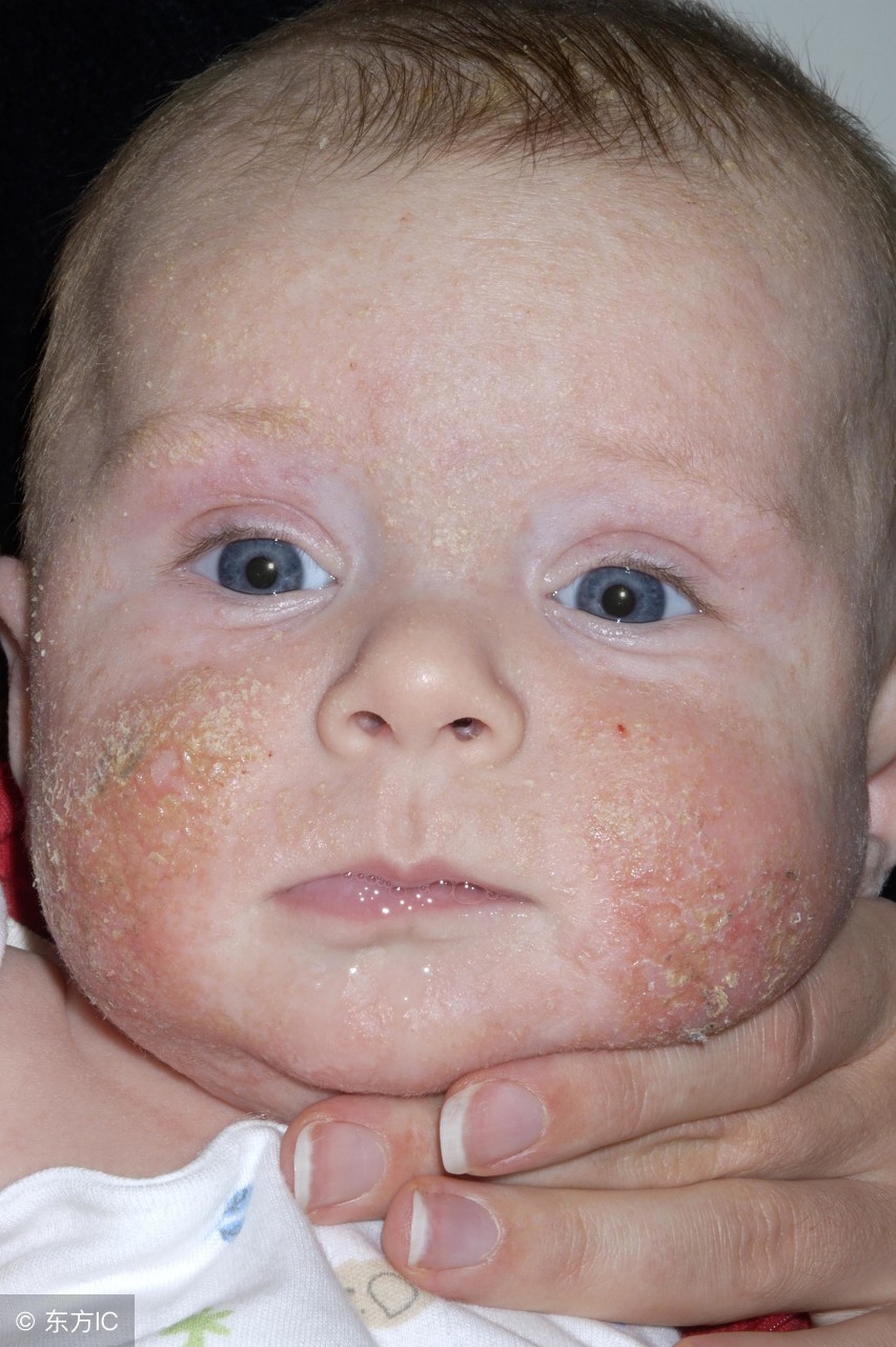 与湿疹抗战三载，四个湿疹“后遗症”并没想象中那么可怕
