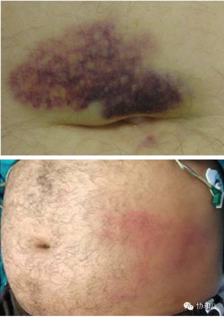 急性胰腺炎检查口诀,一份完整的急性胰腺炎病历