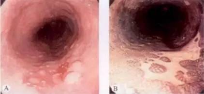 早期食管癌用内镜可以根除吗,超声内镜可以查出早期食管癌吗