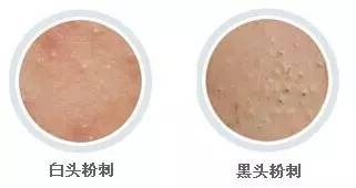 CiCi年希老师：闭口粉刺是什么？那么多人分不清楚它和痘痘的关系