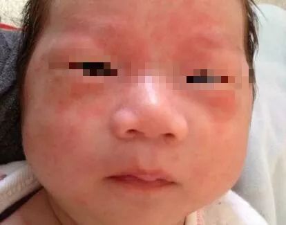 春风一起，怎么娃儿的皮肤就变粗糙了？面部还经常出红疹？