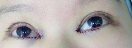 睫毛往眼睛里面长怎么回事,眼睫毛总是戳进眼睛为什么