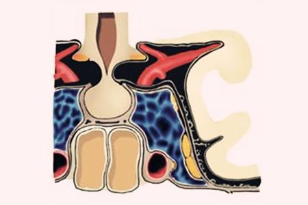 颈动脉海绵窦瘘手术医保能报多少,颈动脉海绵窦瘘术后复视多久恢复