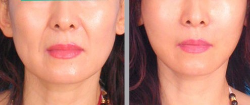 唇纹深怎么去除医美,男士唇纹去除神器