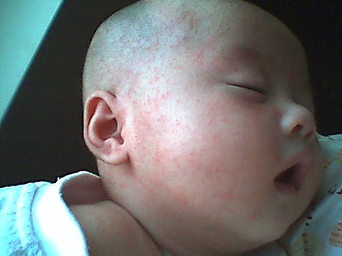 婴儿脸蛋一边红白的是奶癣吗,宝宝脸有奶癣怎么办
