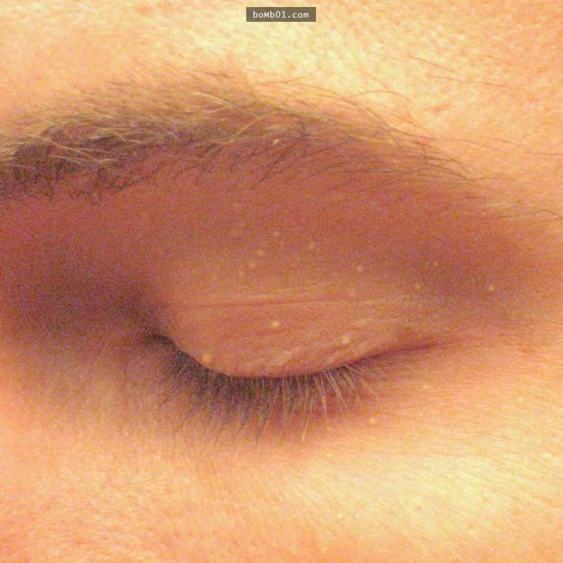 上眼皮上冒出来一个小白点,眼皮上有颗乳白色的小点