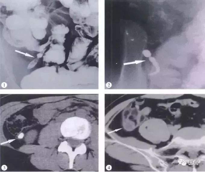 阑尾的解剖和影像表现,阑尾炎的32种鉴别诊断