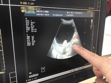 七岁女童肚子里有巨型畸胎瘤,16岁女孩肚子有畸胎瘤怎么治