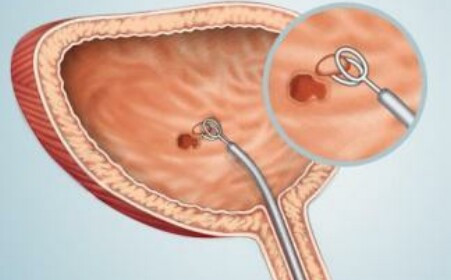 如何治疗膀胱癌,膀胱癌靶向治疗