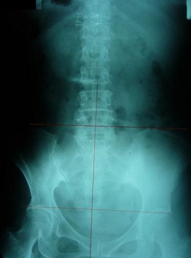 屁股歪了,屁股歪了最佳治疗方法