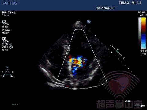 二尖瓣充血性囊肿,二尖瓣血性囊肿是什么意思