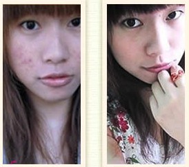 痘痘长哪里不烦人,痘痘在哪几个地方不要挤掉