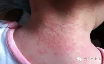 夏天宝宝长痱子能用炉甘石洗剂吗,夏季宝宝长痱子擦什么不会长