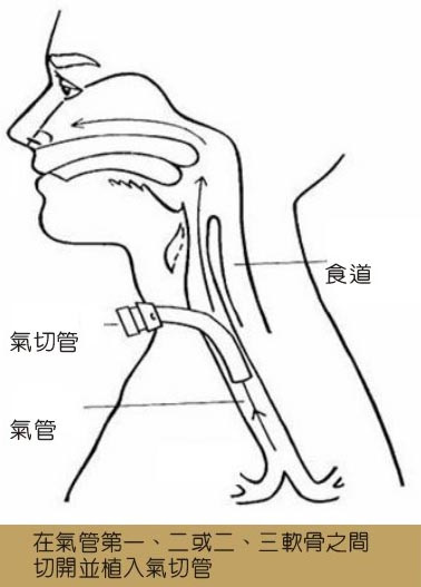 气管切开术急救切哪里,气道切开急救