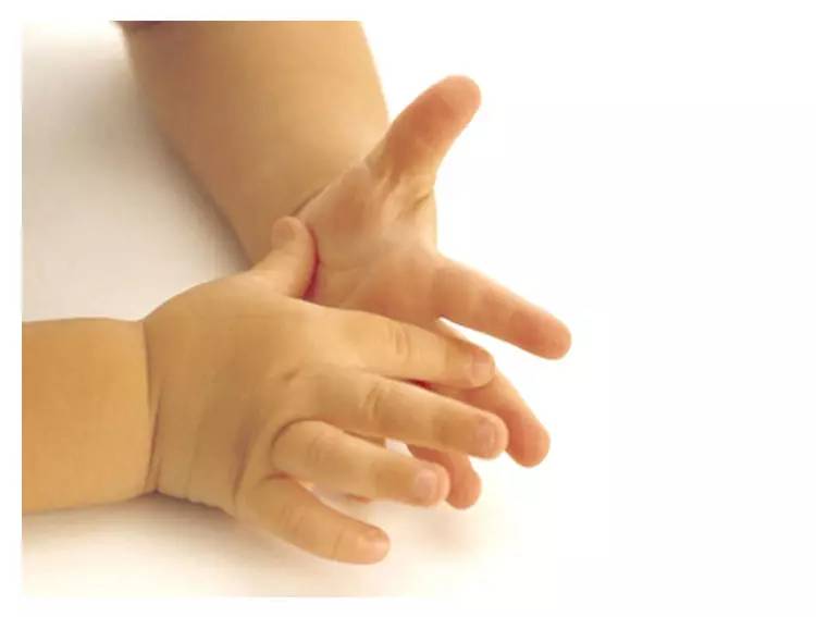 十天宝宝自己怎么判断黄疸,宝宝黄疸护理方法