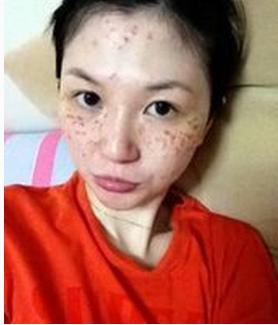 这样些治疗色素斑的方法最安全,你知道吗?