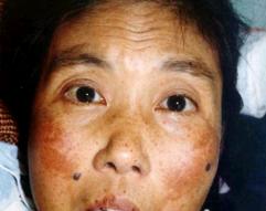 月季哪些因素会引起黑斑,黑斑是怎么造成的