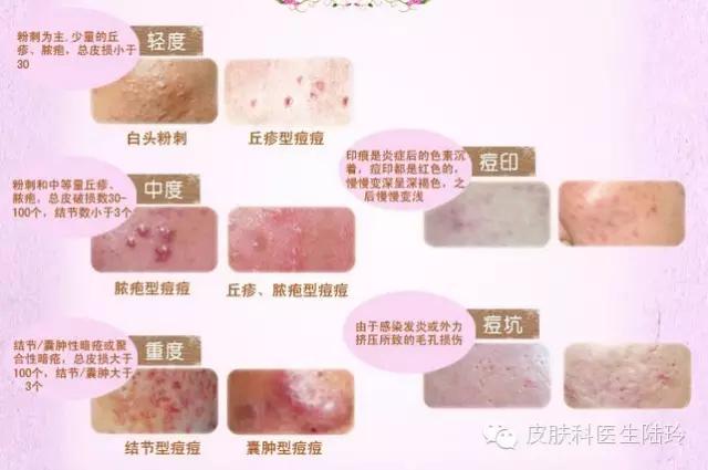 滚蛋吧痘痘君强迫症,滚蛋吧痘痘君图片