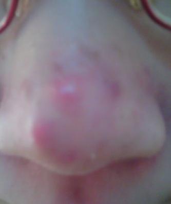 痘痘发炎红肿多久能消退,痘痘发炎红肿怎么办要割掉吗