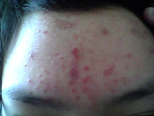 青春期额头上长痘痘是什么原因,30多岁额头长痘痘是什么原因