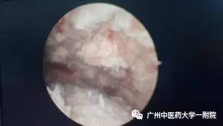 「女科荟」快速去内膜，保留子宫！诺舒，一种治疗月经过多的微创新方法