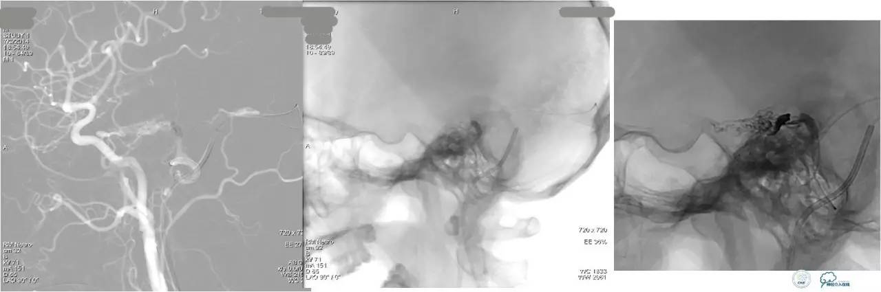 球囊辅助Onyx栓塞治疗硬脑膜动静脉瘘（DAVF）