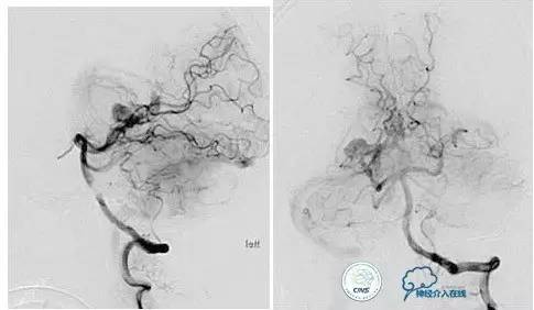 球囊辅助Onyx栓塞治疗硬脑膜动静脉瘘（DAVF）