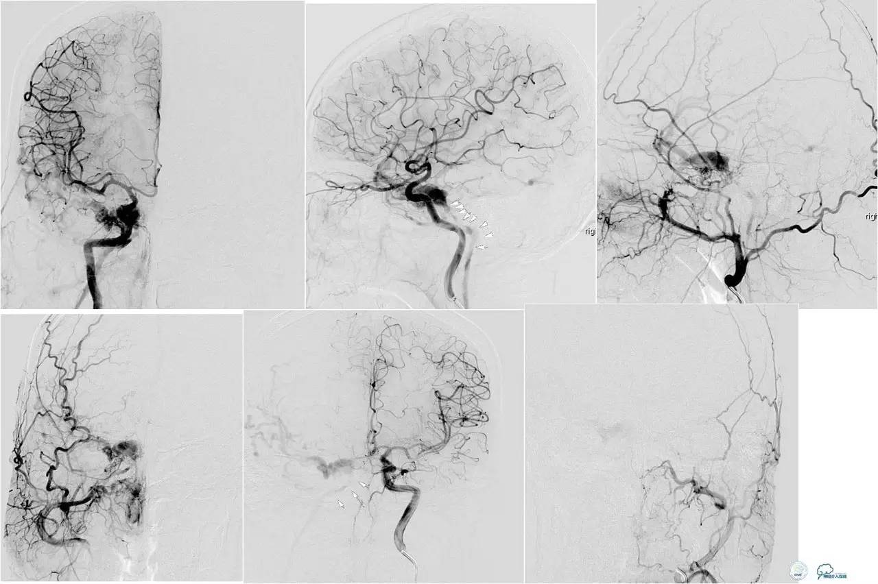 球囊辅助Onyx栓塞治疗硬脑膜动静脉瘘（DAVF）