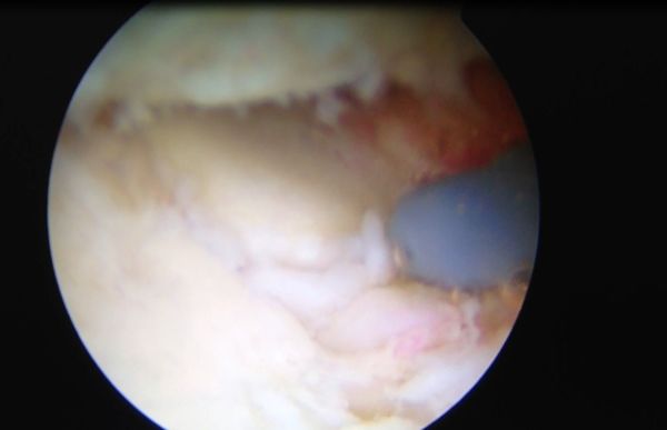 20年前肘关节伸不直,肘关节手术失败十几年伸不直