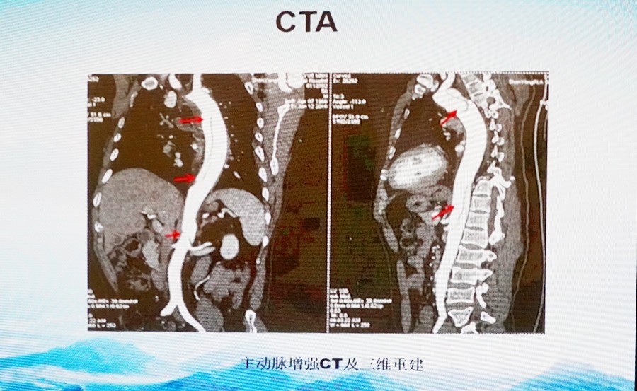 CCCPNCF2016勇攀高峰!主动脉夹层手术直播