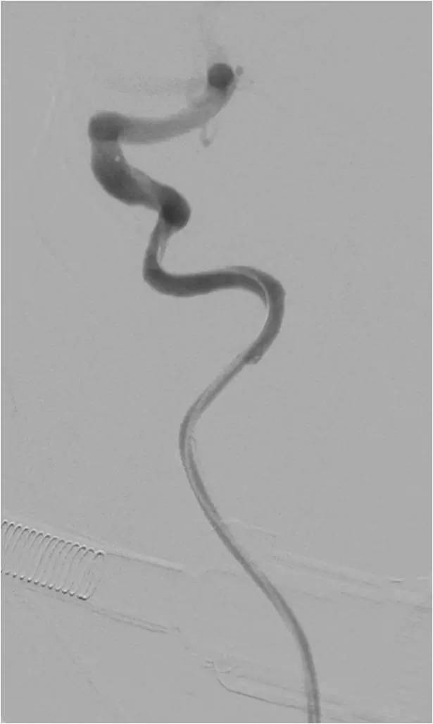 急性缺血性脑卒中血管内治疗,缺血性脑血管病的抗血小板药治疗