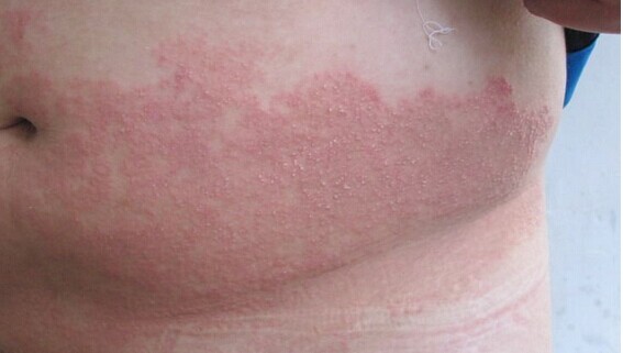 治脚癣手癣最有效的偏方,除去脚癣的中药有什么